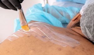 Clear Back Acne in 8 Weeks: The Exact Home Routine That Works