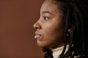 Foods That Cause Acne Flare-Ups: 5 Proven Products That Work (2026)