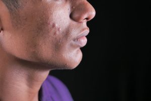 How to Shrink a Pimple Overnight: 5 Myths Dermatologists Want You to Stop Believing